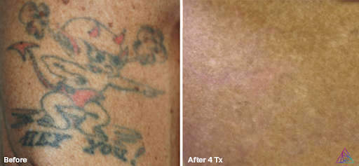 Explore vegeta tattoo ideas, creative tattoo ideas in Rowlett, available at Bonsai Laser Tattoo Removal