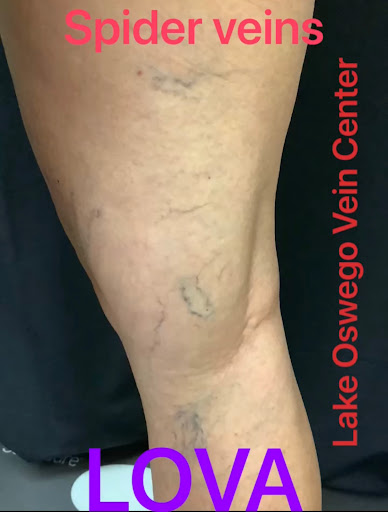 Explore four horsemen tattoo ideas, creative tattoo ideas in Lake Oswego, available at Lake Oswego Vein and Aesthetic LOVA