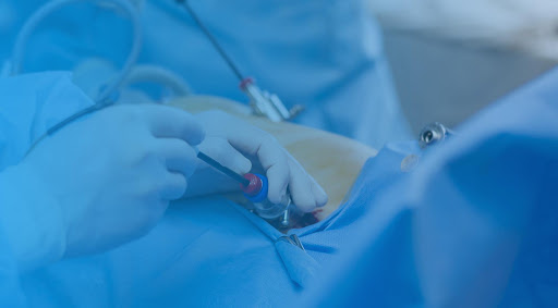 ⊛ Cirugia Laparoscopica en Aguascalientes - Undoctorparati