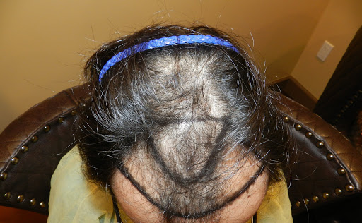 Hair Replacement Service «Medical Hair Transplants & Aesthetics», reviews and photos, 15055 Los Gatos Blvd Suite #110, Los Gatos, CA 95032, USA