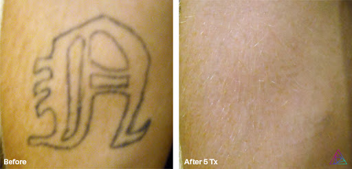 Explore rising sun tattoo ideas, creative tattoo ideas in Fort Myers, available at Laser Tattoo Removal by Tatt Cemetery