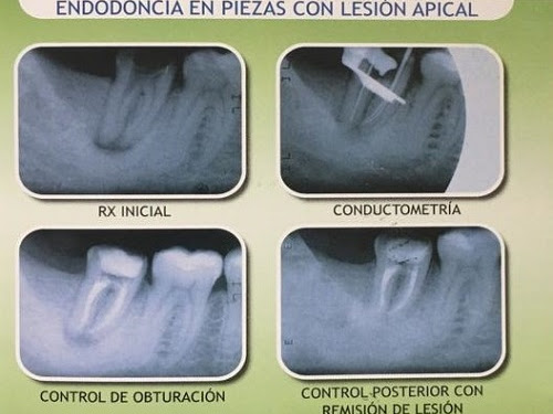 Clinica Dental Endodoncista Francisco Astudillo - Cuenca