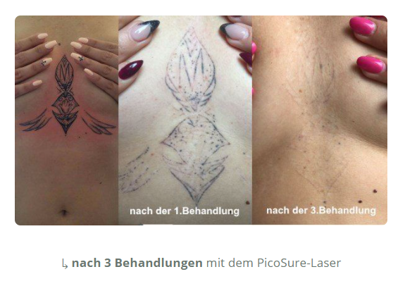 Tattooentfernung Kreuzlingen - Tattoostudio