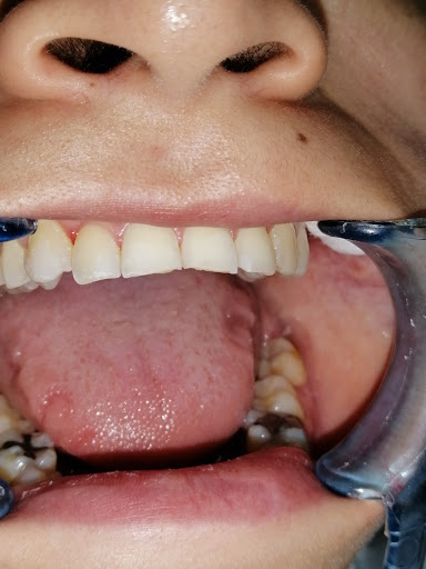 Dr.ernesto Camarena. implantes dentales.