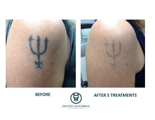 Explore shamrock tattoo ideas, creative tattoo ideas in San Diego, available at Removery Tattoo Removal & Fading