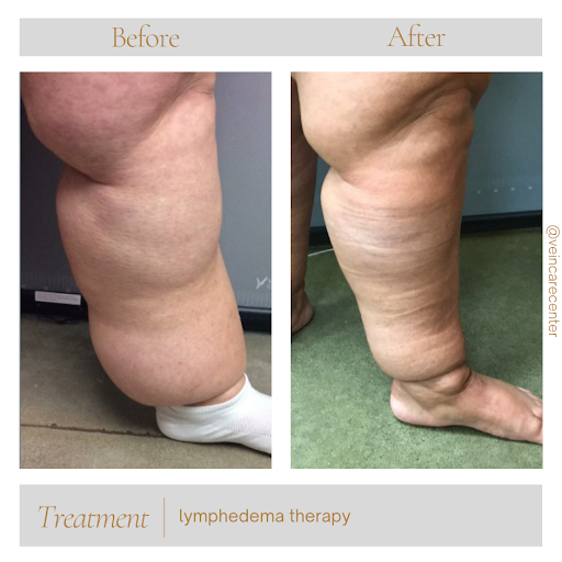 Explore memorial tattoo ideas for grandma, creative tattoo ideas in Lima, available at Vein Care Center Laser Specialists