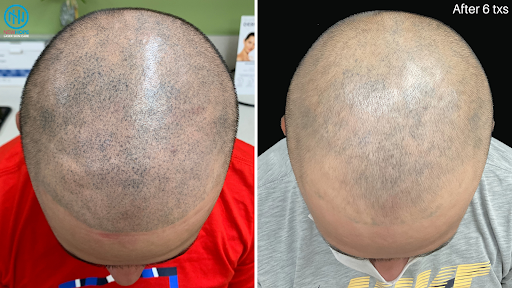 Explore tattoo ideas for freedom, creative tattoo ideas in Westminster, available at Newhope Laser Skin Care