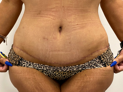 Liposuction clinics Orlando