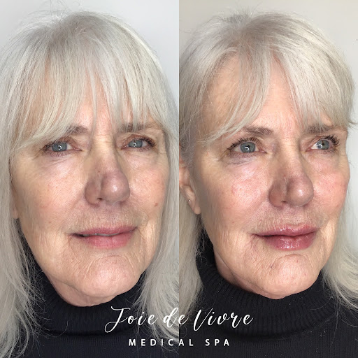 Explore bald head tattoo ideas, creative tattoo ideas in Canton, available at JDV Med Spa