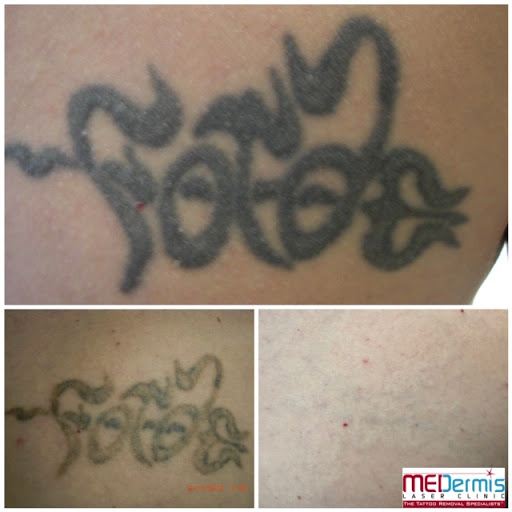 Explore black and grey half sleeve tattoo ideas, creative tattoo ideas in San Antonio, available at MEDermis Tattoo Removal