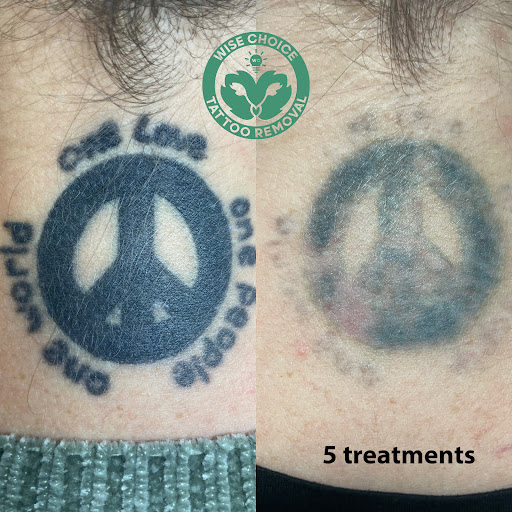 Explore rodeo tattoo ideas, creative tattoo ideas in Denver, available at Wise Choice Tattoo Removal