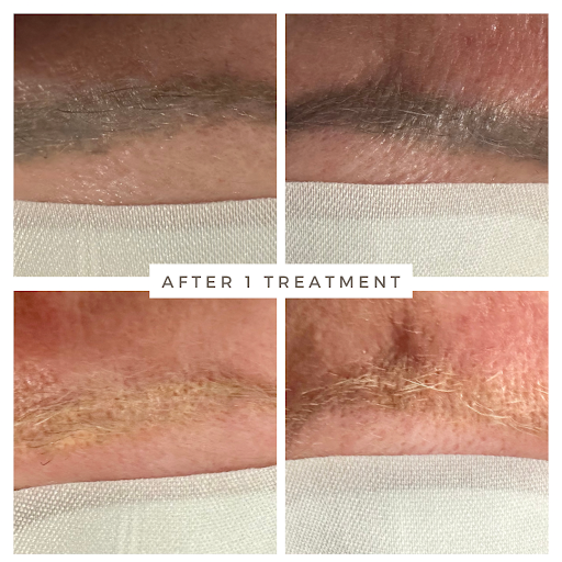 Explore charlie brown tattoo ideas, creative tattoo ideas in Mckinney, available at Premier Tattoo Removal