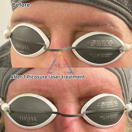 Explore butterfly tattoo ideas on arm, creative tattoo ideas in New York, available at Ag2g Laser Tattoo Removal & MedSpa