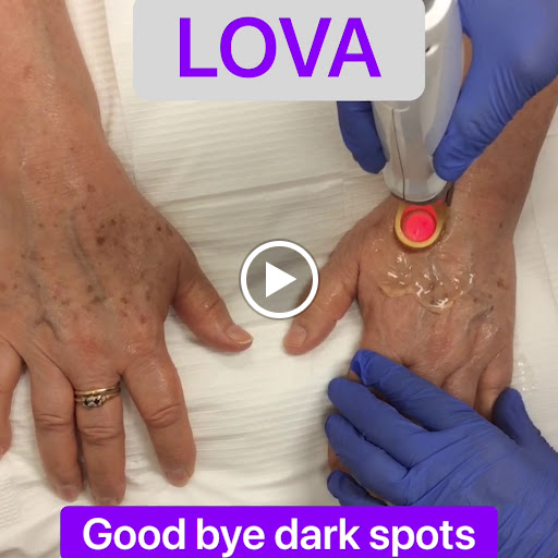 Explore tramp stamp lower back tattoo cover up ideas, creative tattoo ideas in Lake Oswego, available at Lake Oswego Vein and Aesthetic LOVA