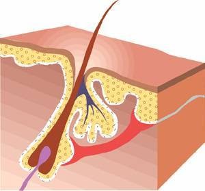 Hairadicator Electrolysis 36609