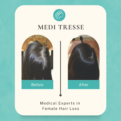 Medi Tresse Worcester - Female Hair Loss Experts