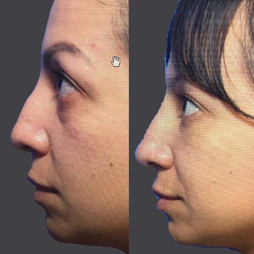 Explore cicada tattoo ideas, creative tattoo ideas in Whittier, available at Skin Perfect Medical Aesthetics