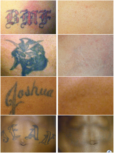 Explore buffalo bills tattoo ideas, creative tattoo ideas in San Diego, available at Evolve Tattoo Removal