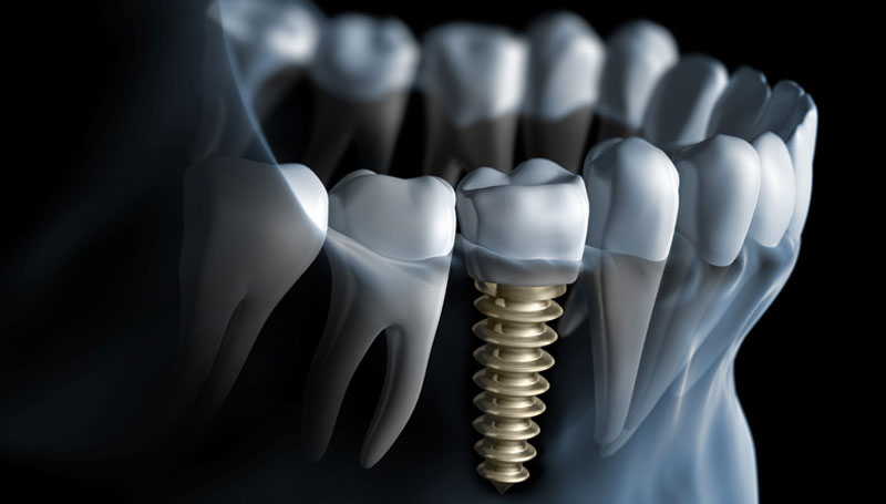 Klinik Dental Implant Jakarta Photo