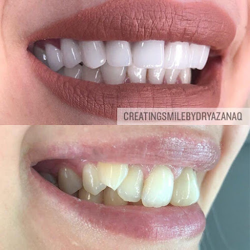 Opinii despre Creating Smile by Dr.Yazan Aq • Fatete dentare Emax • Implanturi dentare Bucuresti • Fatete ceramice dinti Emax CAD • coroane dentare • coronite ceramica • recomandari VIP • Hollywood Smile veneers în <nil> - Clinică de chirurgie plastică