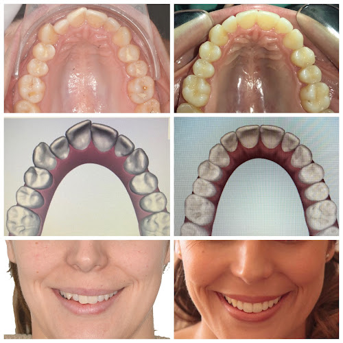 Invisalign - Damon System - Ortodoncia Uruguay - Dentista