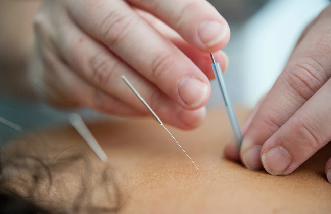 Reviews of Acupunture Coventry in Coventry - Doctor