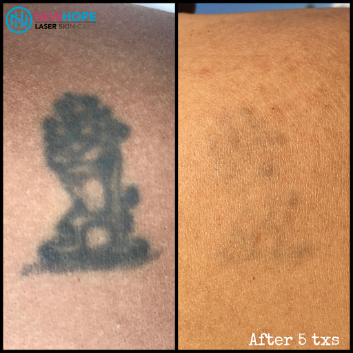 Explore family portrait tattoo ideas, creative tattoo ideas in Westminster, available at Newhope Laser Skin Care