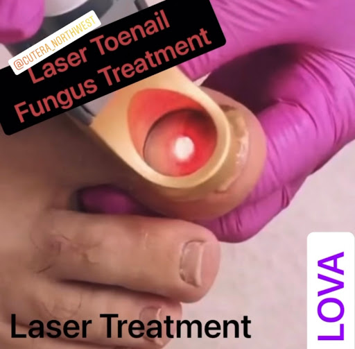 Explore stitch tattoos ideas, creative tattoo ideas in Lake Oswego, available at Lake Oswego Vein and Aesthetic LOVA