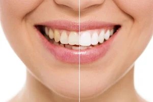 DClieporiai | Odontologijos klinika Šiauliuose | Odontologai Šiauliuose | Dantų protezavimas | Dantų implantai | Balinimas image