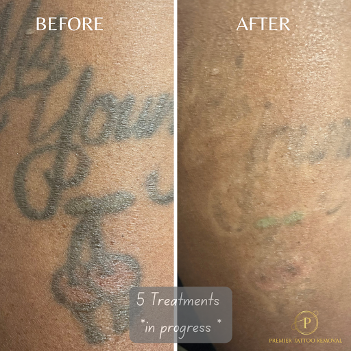 Explore tribal tattoo ideas for guys, creative tattoo ideas in Mckinney, available at Premier Tattoo Removal