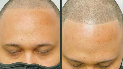 SMP Mobile/Scalp Micropigmentation