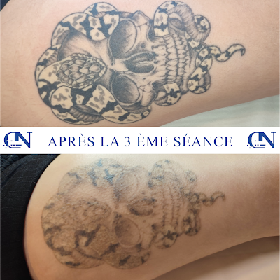 Detatouage Nancy à Nancy