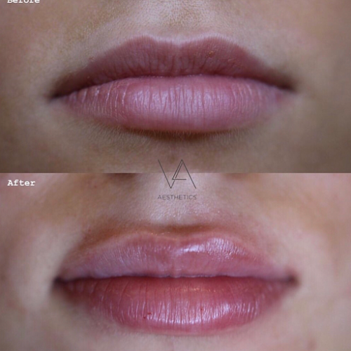 V&A Aesthetics - London Lip Fillers, Chin, Nose, Cheek & Jaw Filler Clinic - Doctor