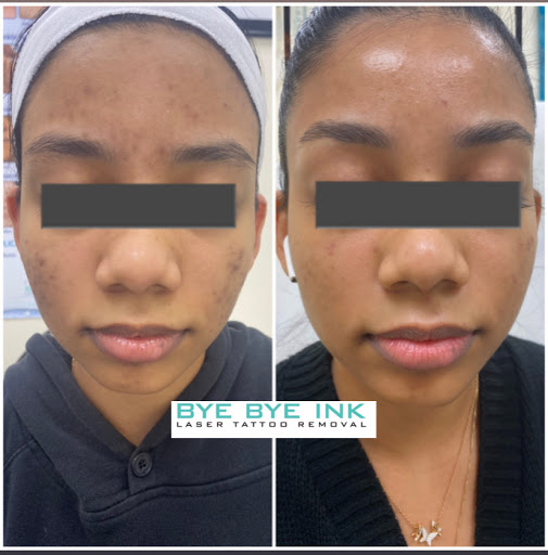 Explore kpop twice tattoo ideas, creative tattoo ideas in Middle Village, available at Bye Bye Ink Laser Tattoo Removal