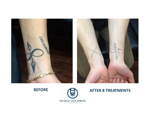 Explore bouquet tattoo ideas, creative tattoo ideas in San Diego, available at Removery Tattoo Removal & Fading