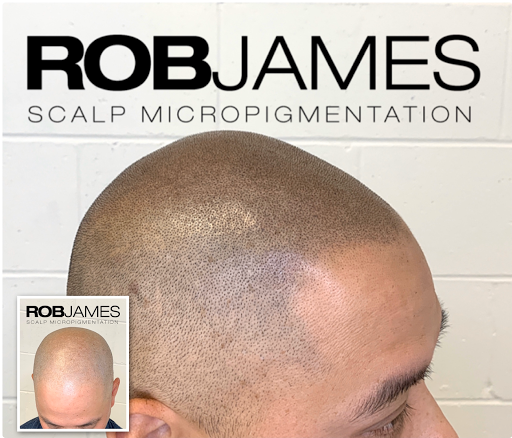 Advanced Scalp Micropigmentation Vancouver, Surrey - Rob James