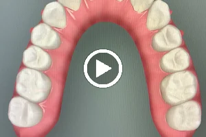 Ortodoncia Invisible LINA TURNER image