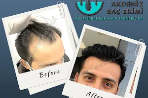 Akdeniz Antalya Saç Ekimi - Hair Transplant Antalya image