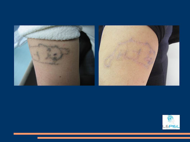 Rejuvenecimiento facial | Lepiel Clinica Laser | Eliminación de tatuajes
