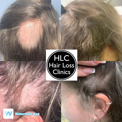 Reading Hair Loss Clinic