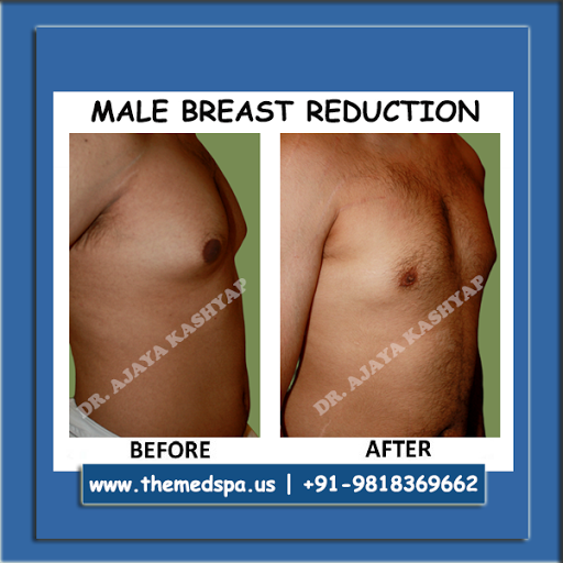 Cosmetic Surgery Clinic Delhi: Best Liposuction Gynecomastia Rhinoplasty Breast Surgery