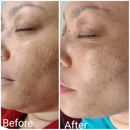 Explore anakin skywalker tattoo ideas, creative tattoo ideas in Brighton, available at Tip of the Spear Laser Esthetics