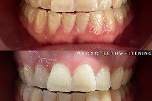 XOXO Teeth Whitening image