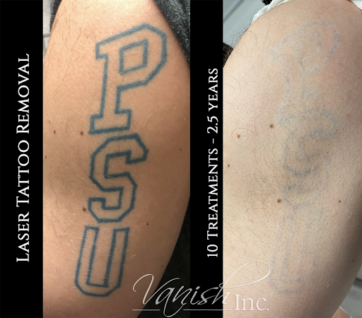 Explore superhero tattoo ideas, creative tattoo ideas in Williamsport, available at Vanish Laser & Skin, Inc.