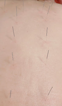 Li Acupuncture Clinic - Photo 3 - Car repair in Syracuse, NY, Syracuse