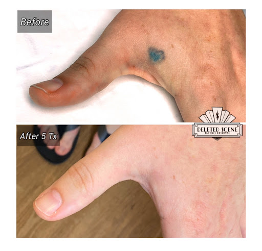 Explore camo tattoo ideas, creative tattoo ideas in Hatboro, available at Deleted Scene Tattoo Removal