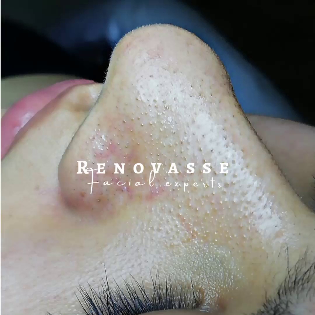 Limpieza facial en cali RENOVASSE