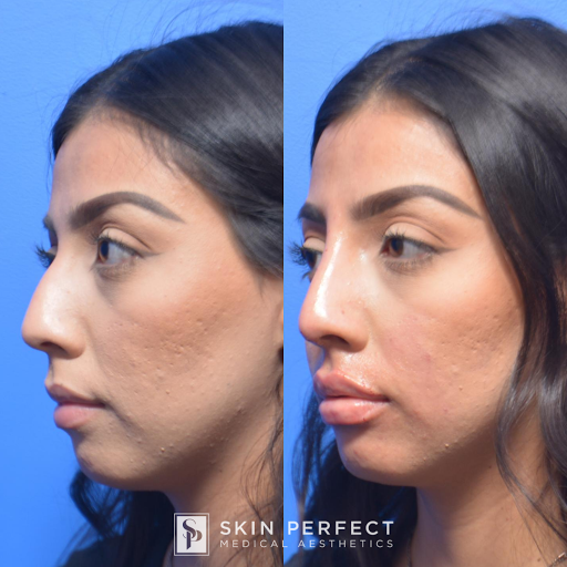 Explore tattoo ideas for weightlifters, creative tattoo ideas in Whittier, available at Skin Perfect Medical Aesthetics