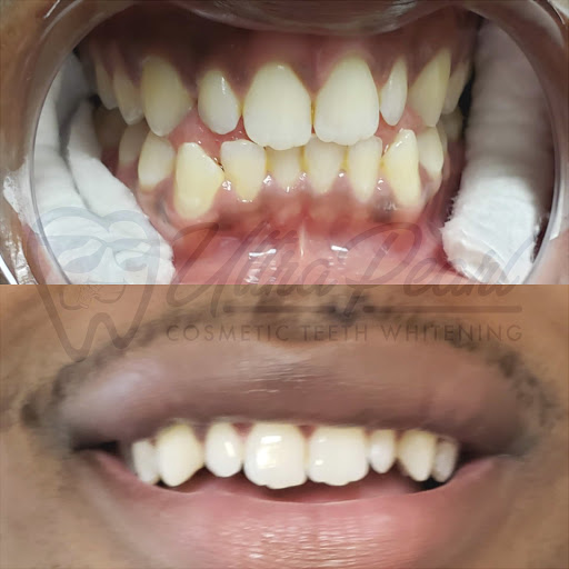 Ultra Pearl Cosmetic Teeth Whitening