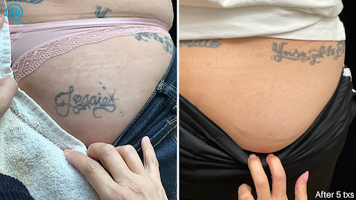 Explore family guy tattoo ideas, creative tattoo ideas in Westminster, available at Newhope Laser Skin Care